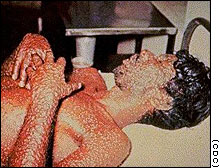 smallpox