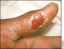 tularemia